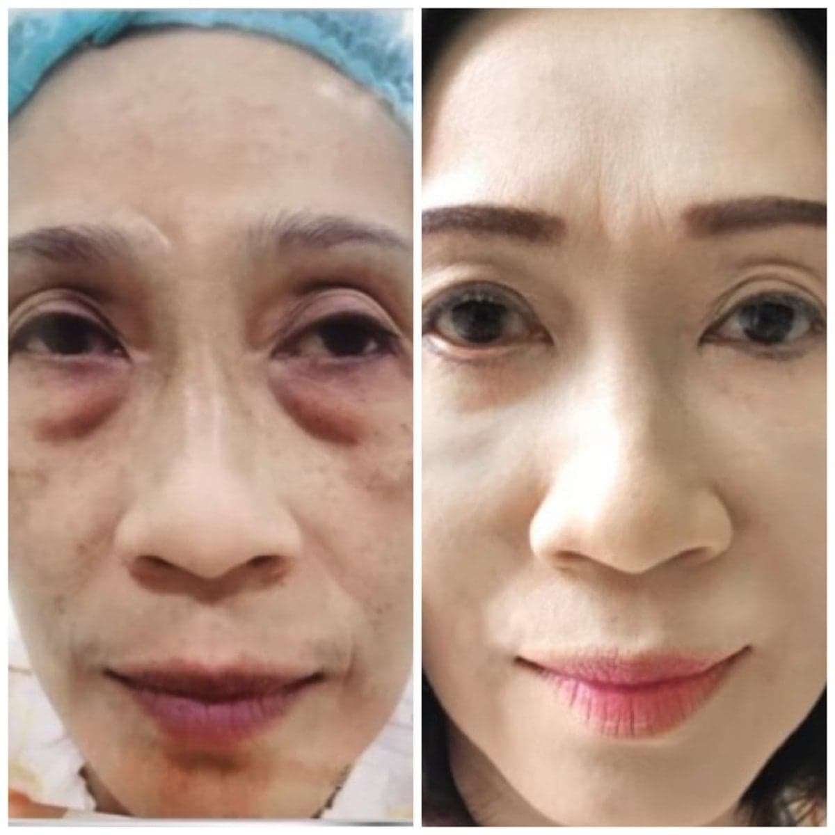 upper eyelid surgery