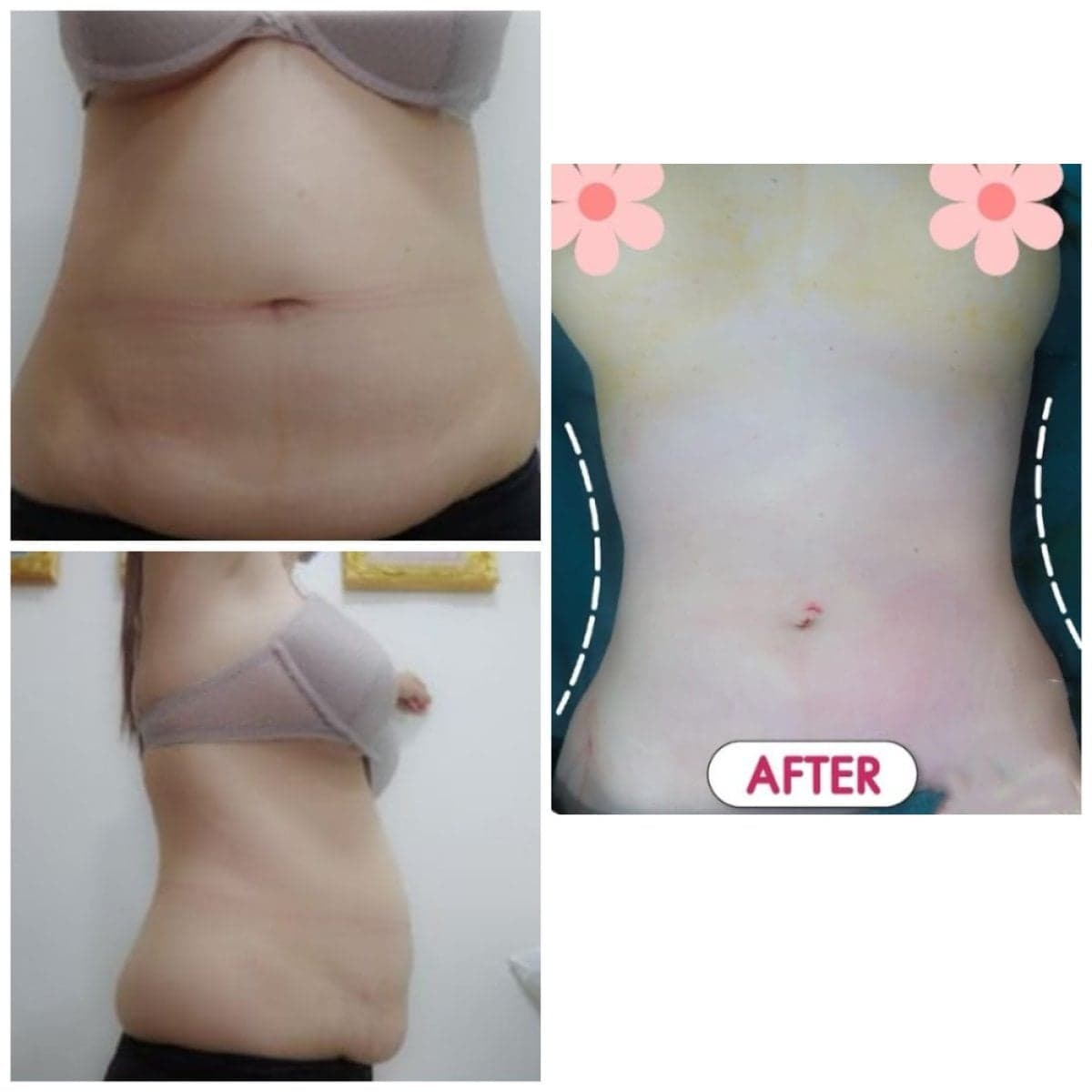 Vaser liposuction