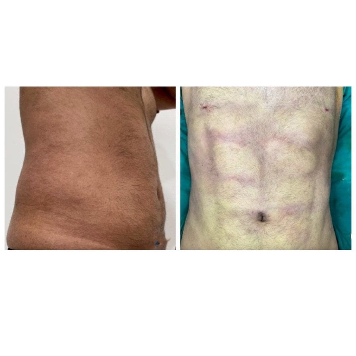 liposuction
