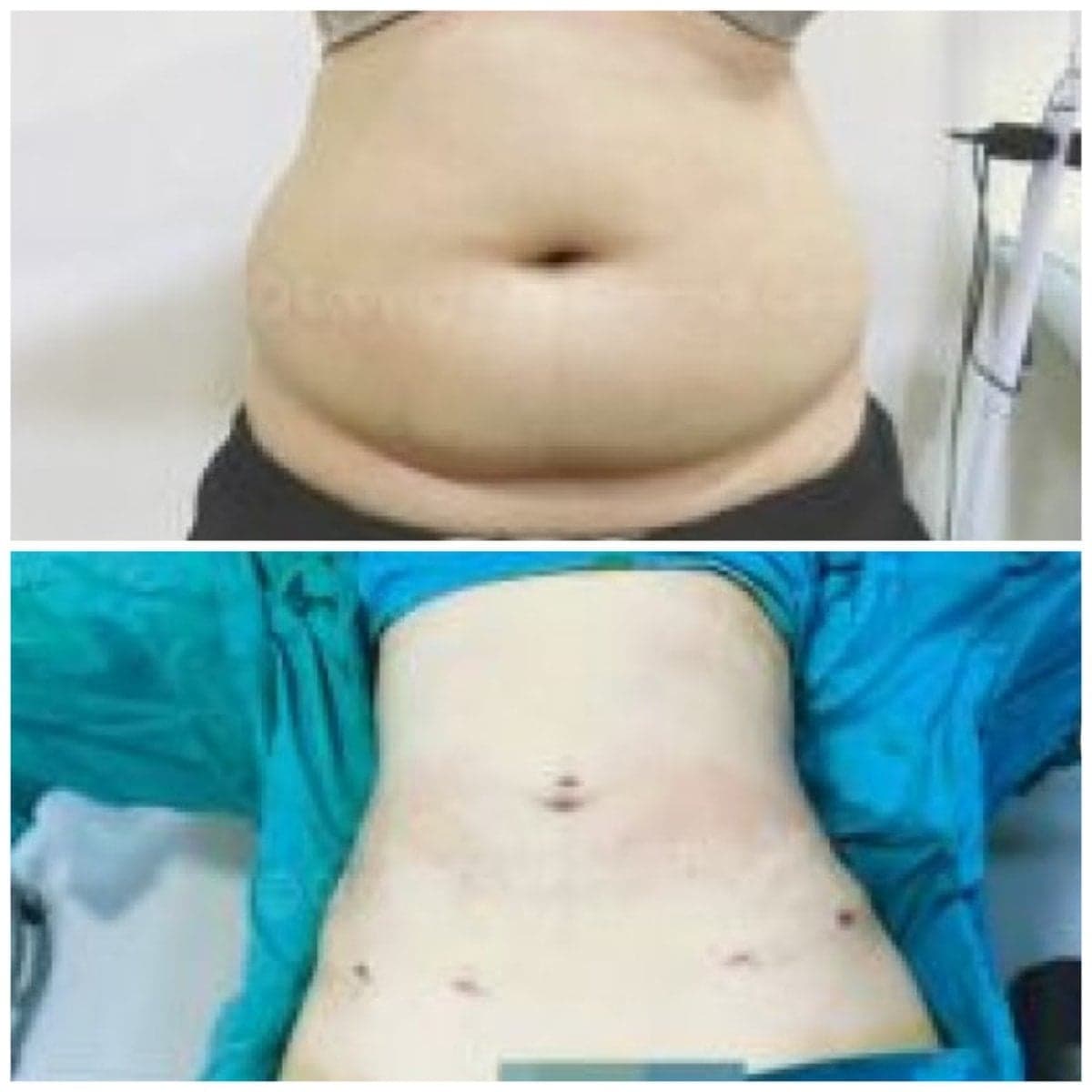 liposuction