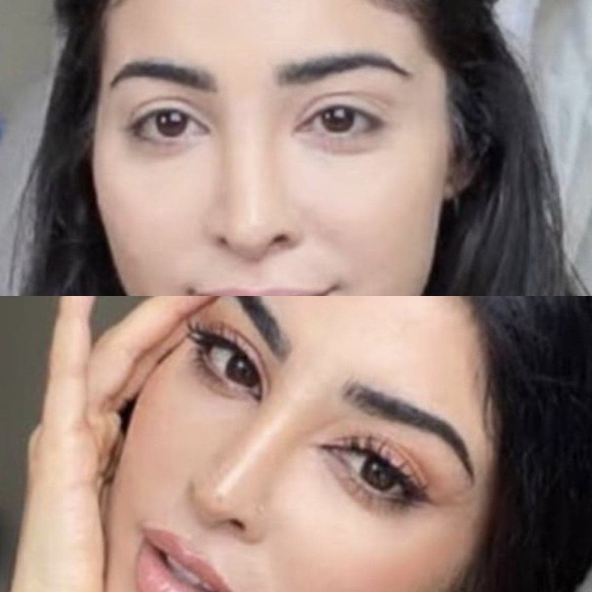 blepharoplasty