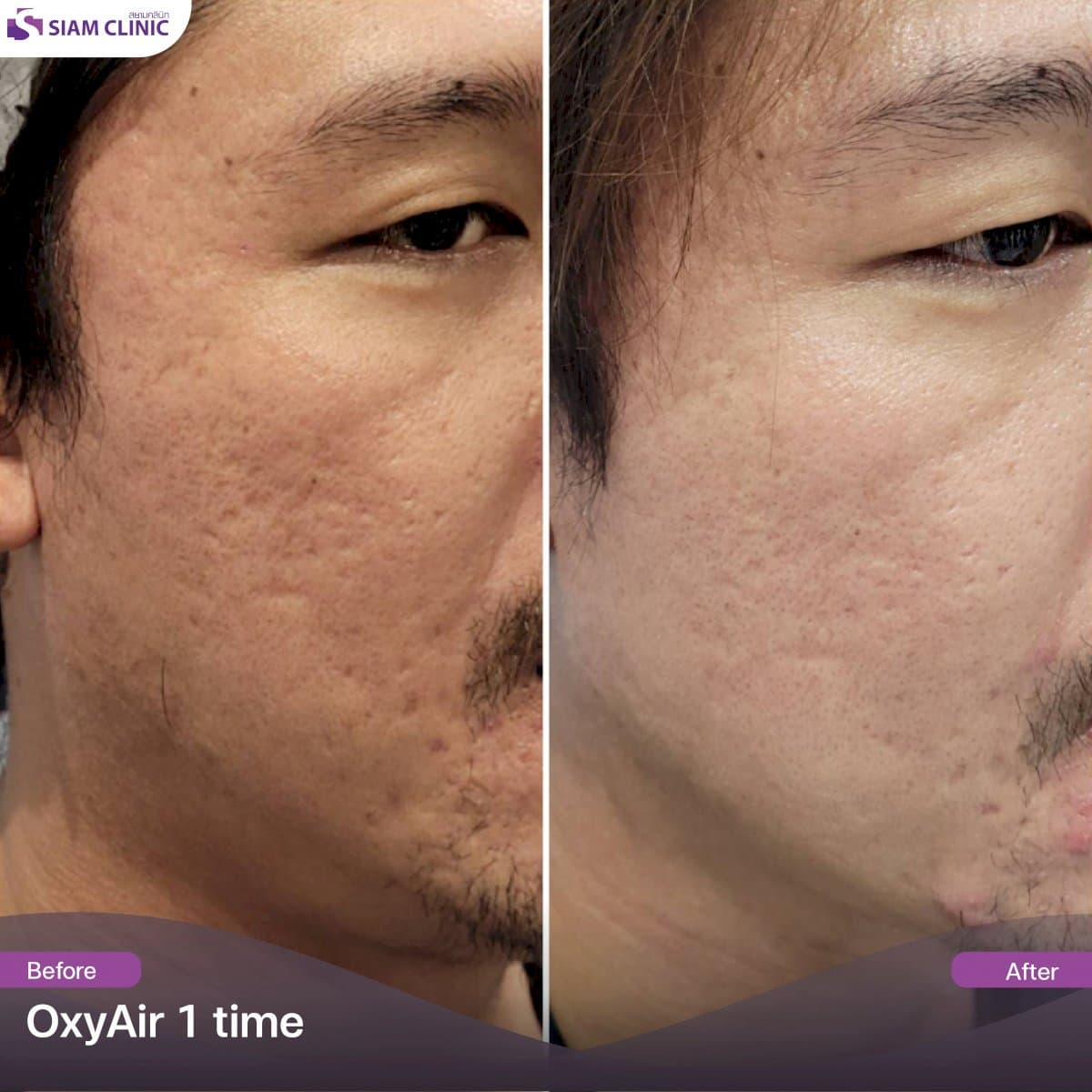 acne scar treatment