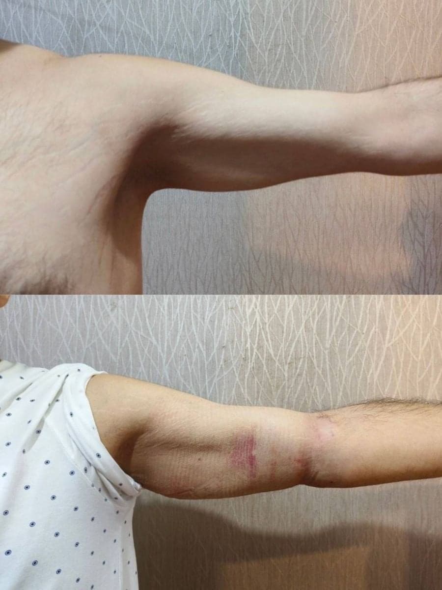 upper arm liposuction