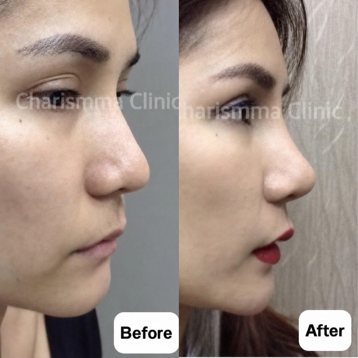open rhinoplasty