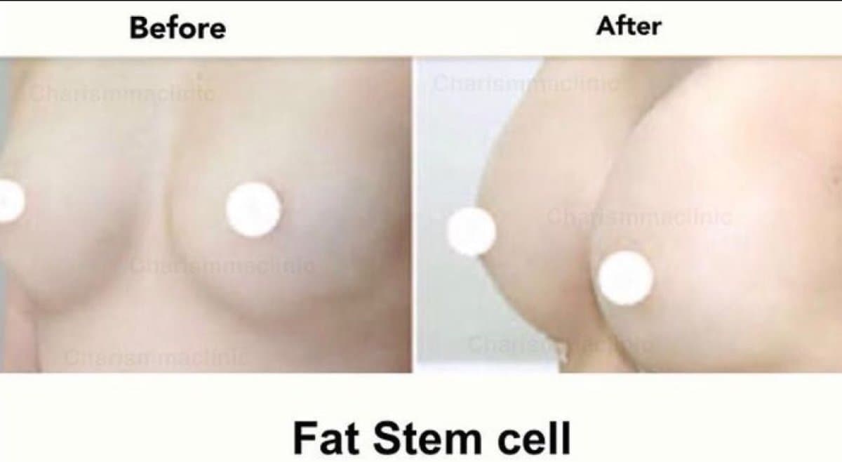 breast augmentation with fat stem cells