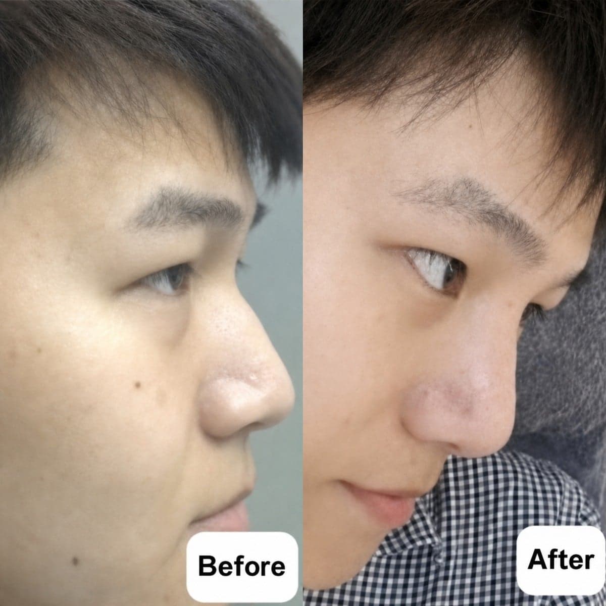 open rhinoplasty