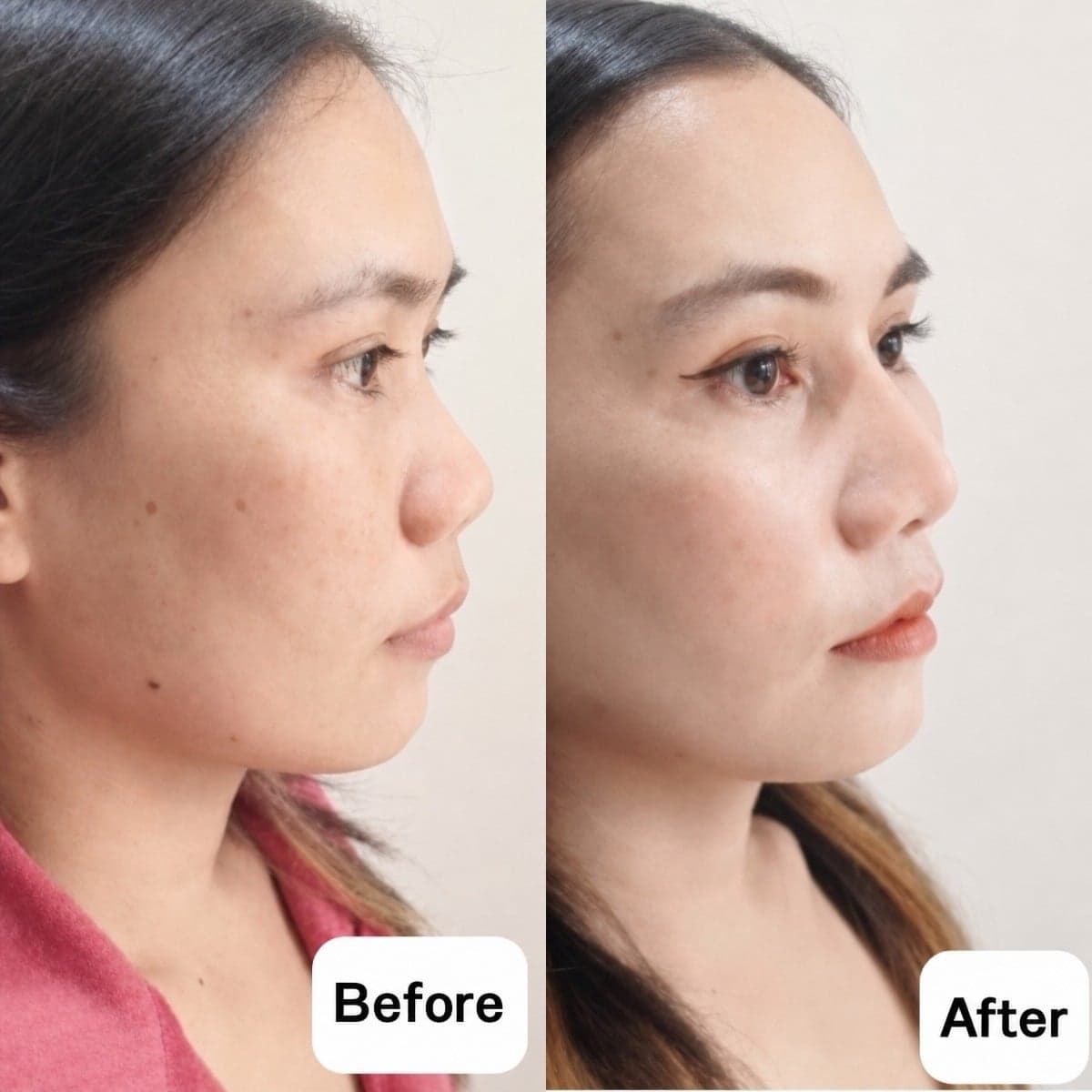 rhinoplasty
