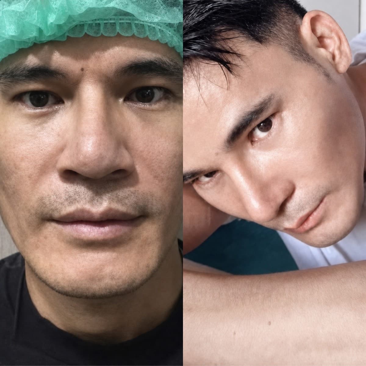open rhinoplasty
