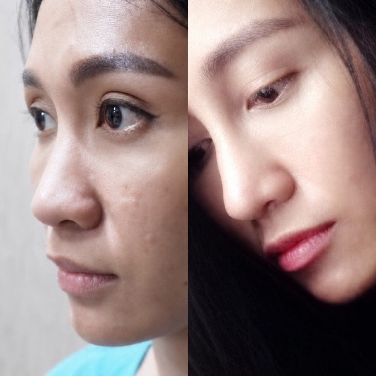 rhinoplasty