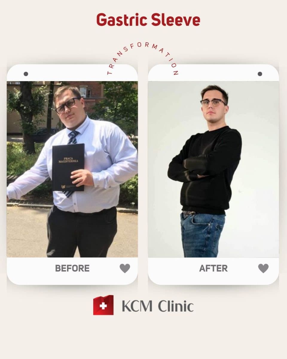 gastric sleeve