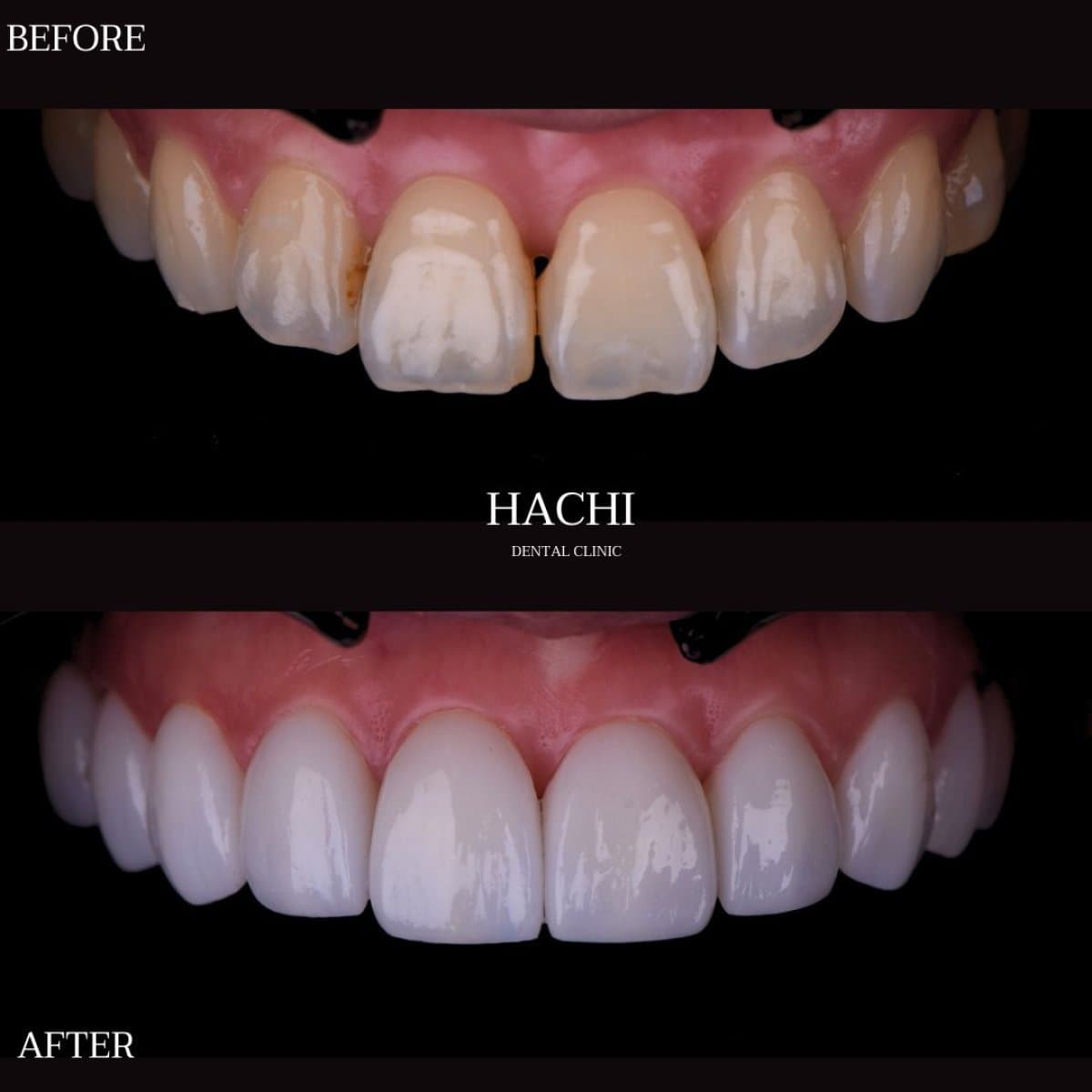 porcelain veneer