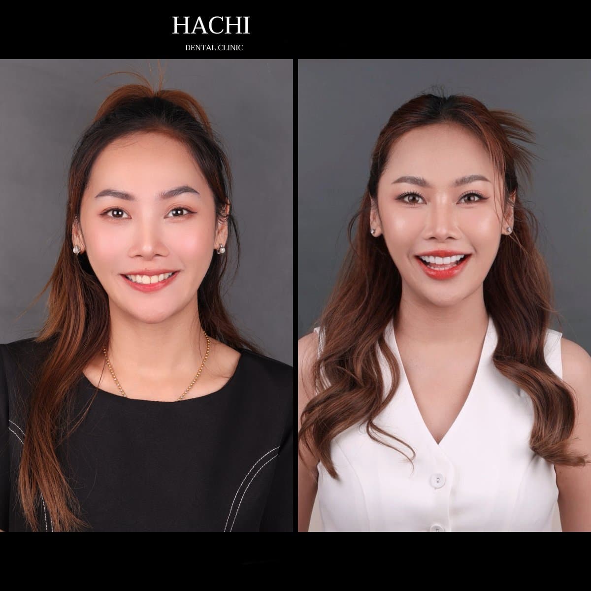 veneers