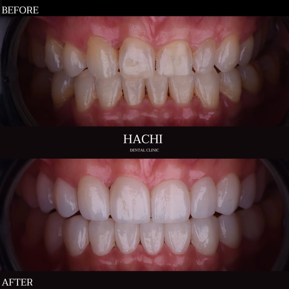 dental veneers