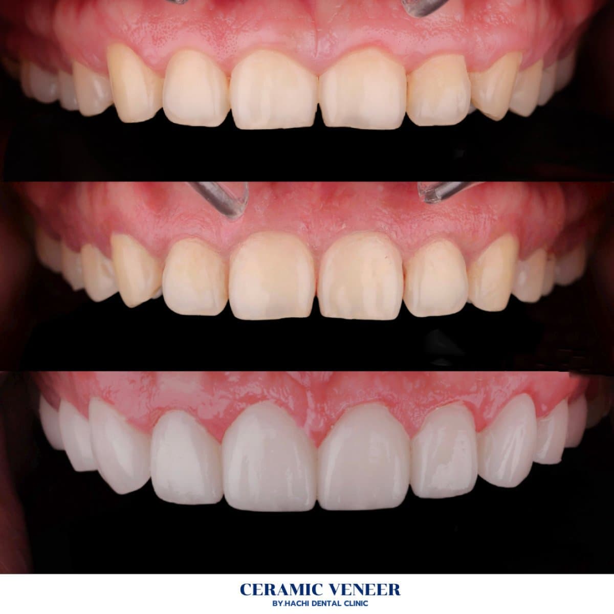 ceramic veneers