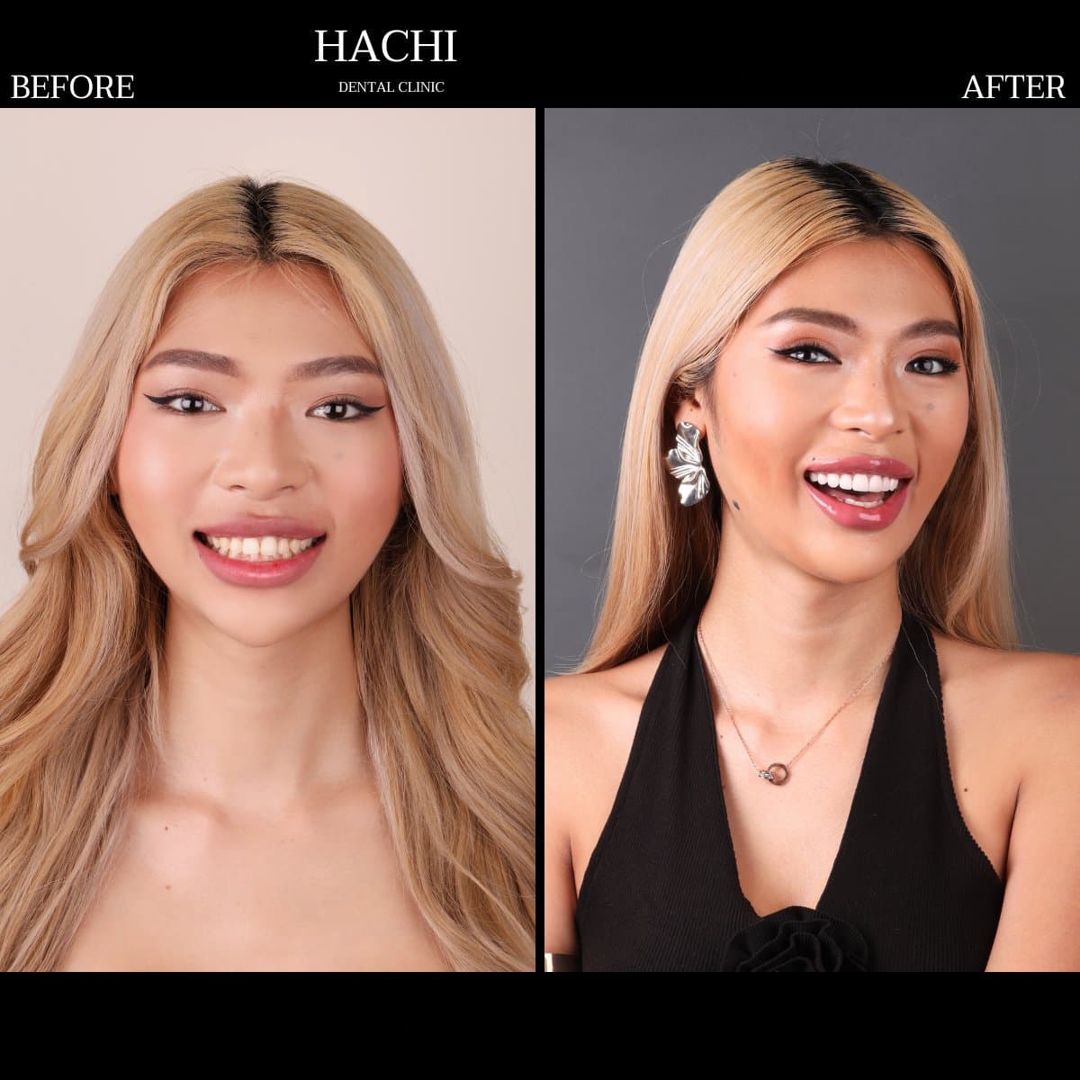veneers