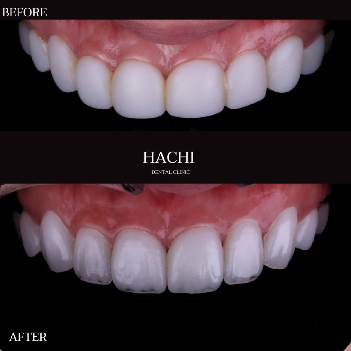 dental veneers