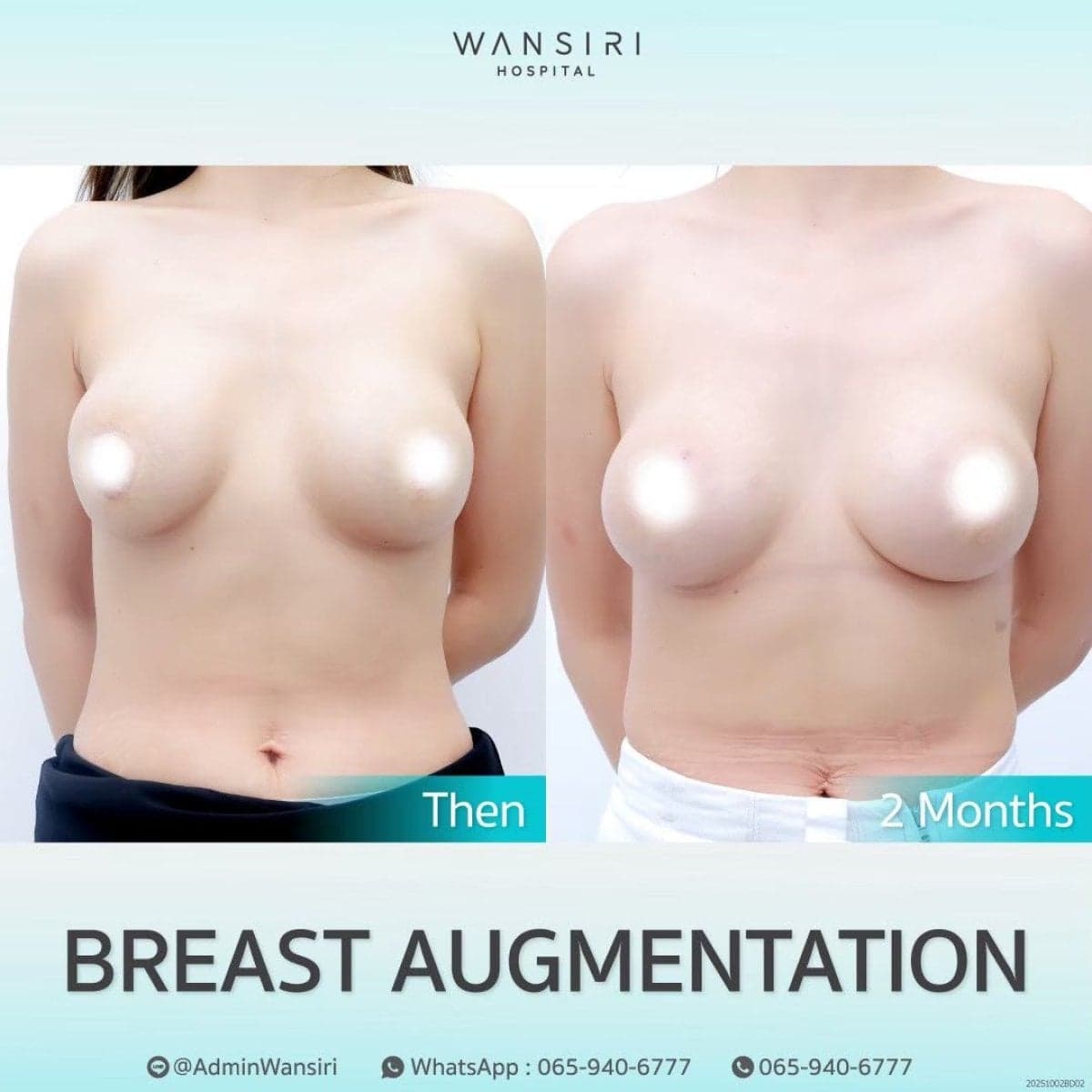 breast augmentation