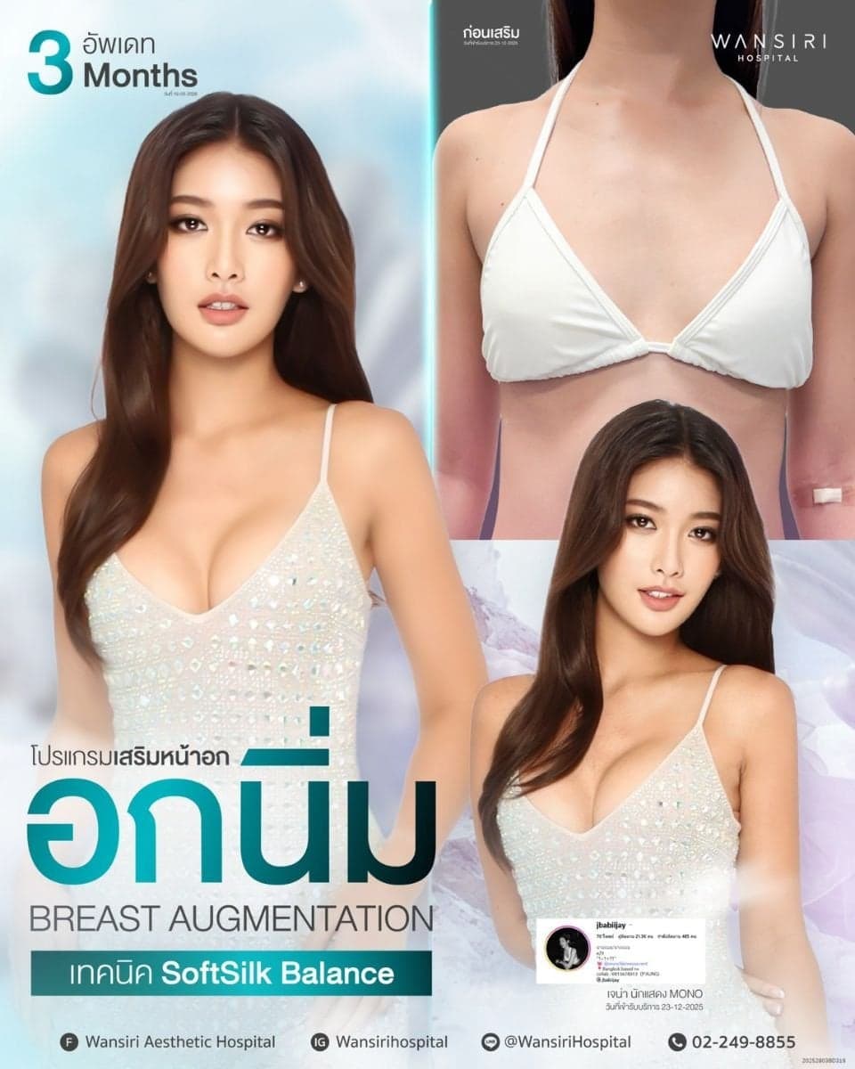 breast augmentation