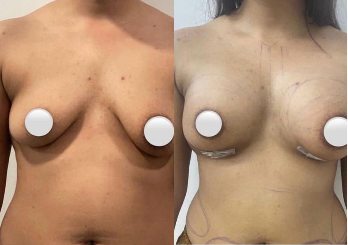 breast augmentation