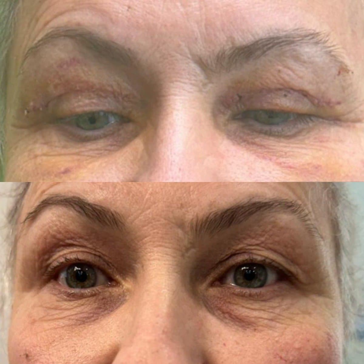 blepharoplasty