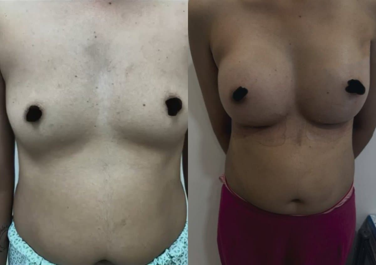 breast augmentation