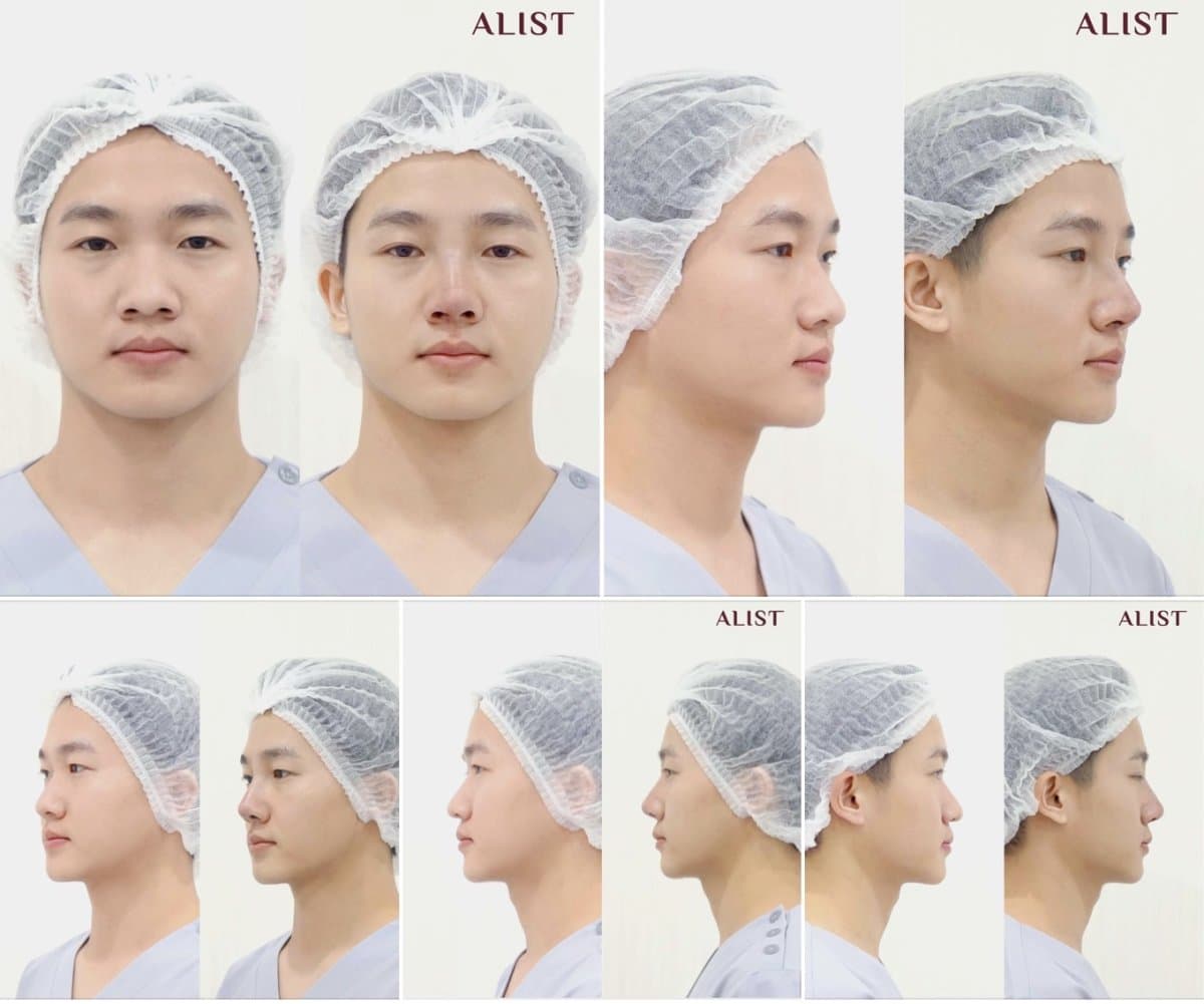 rhinoplasty