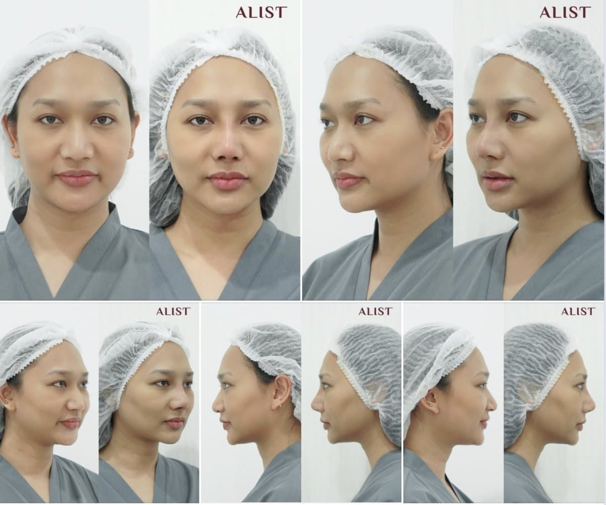 rhinoplasty