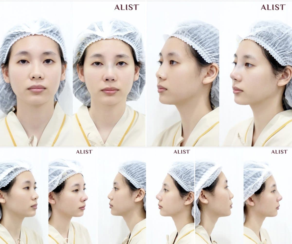 rhinoplasty
