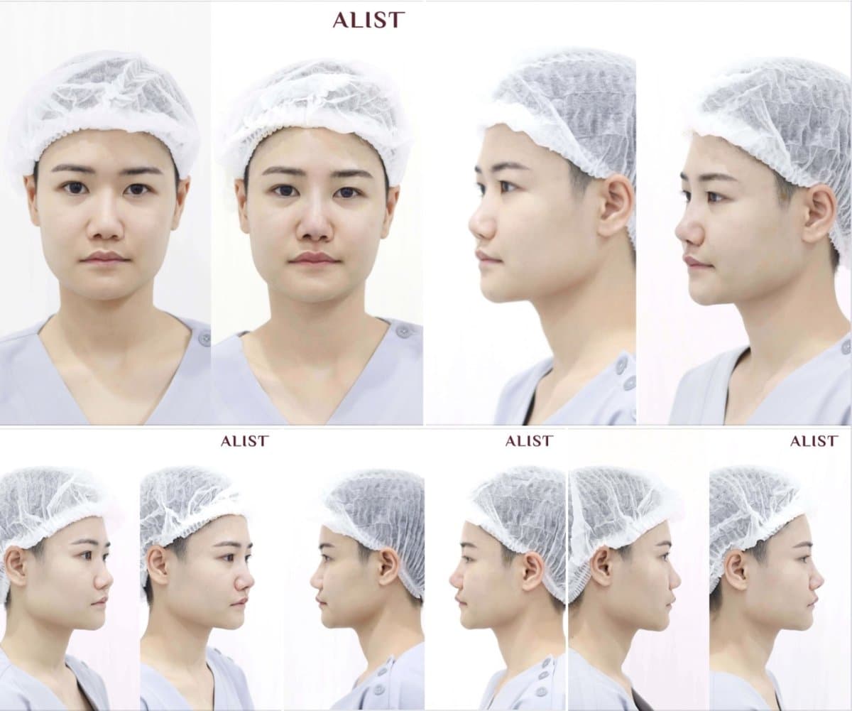 rhinoplasty