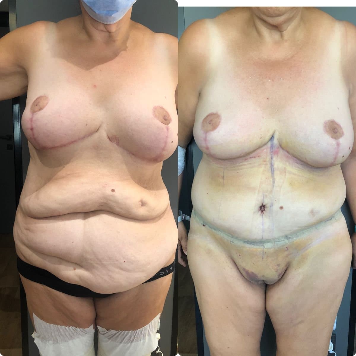 breast lift and tummy tuck