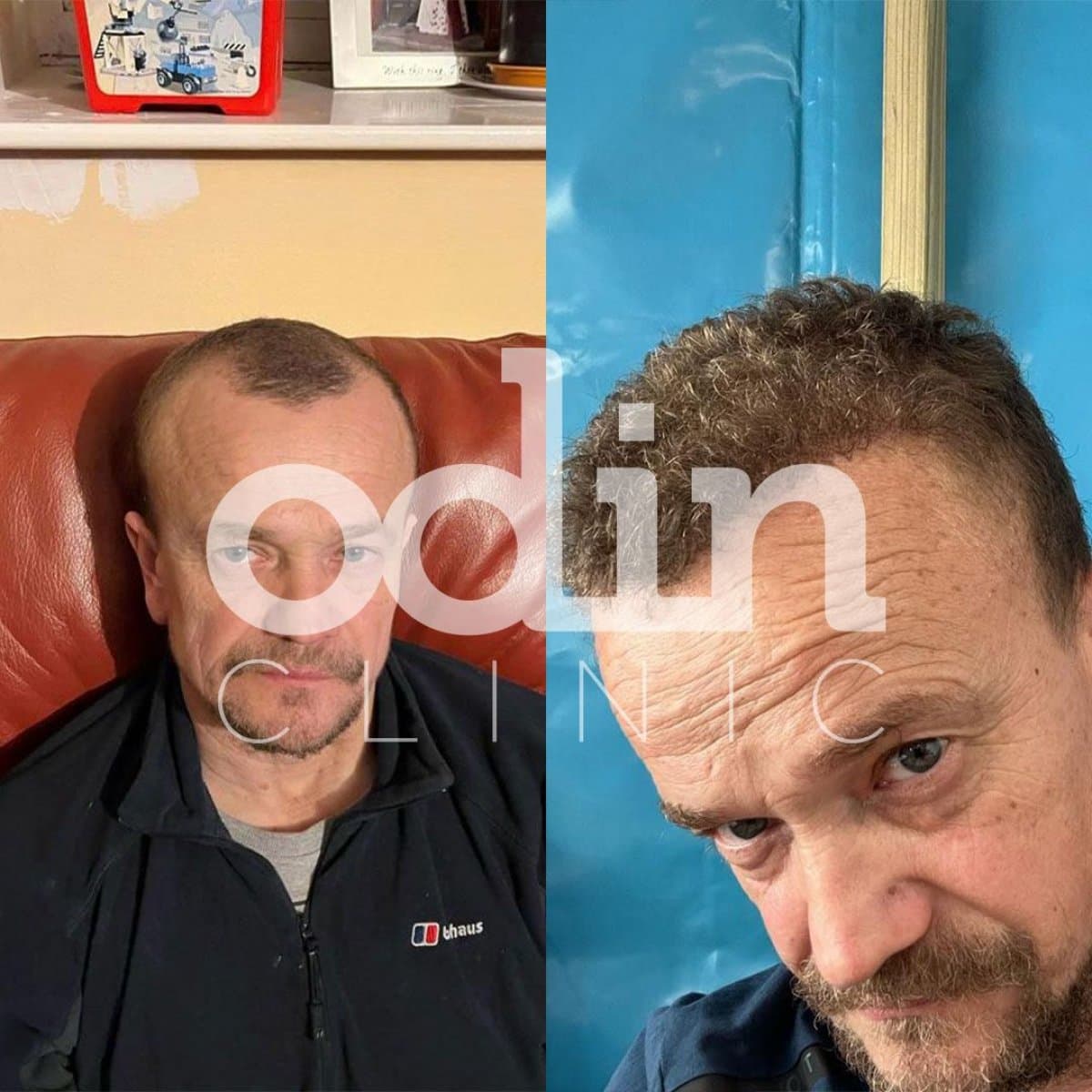 FUE hair transplant