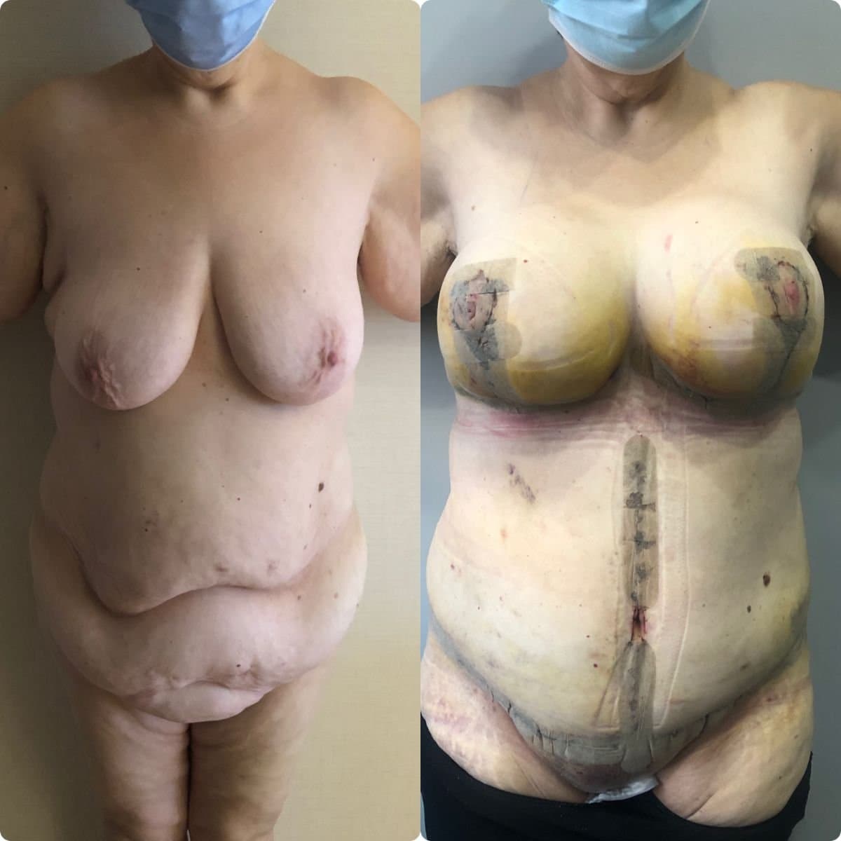 breast lift and tummy tuck