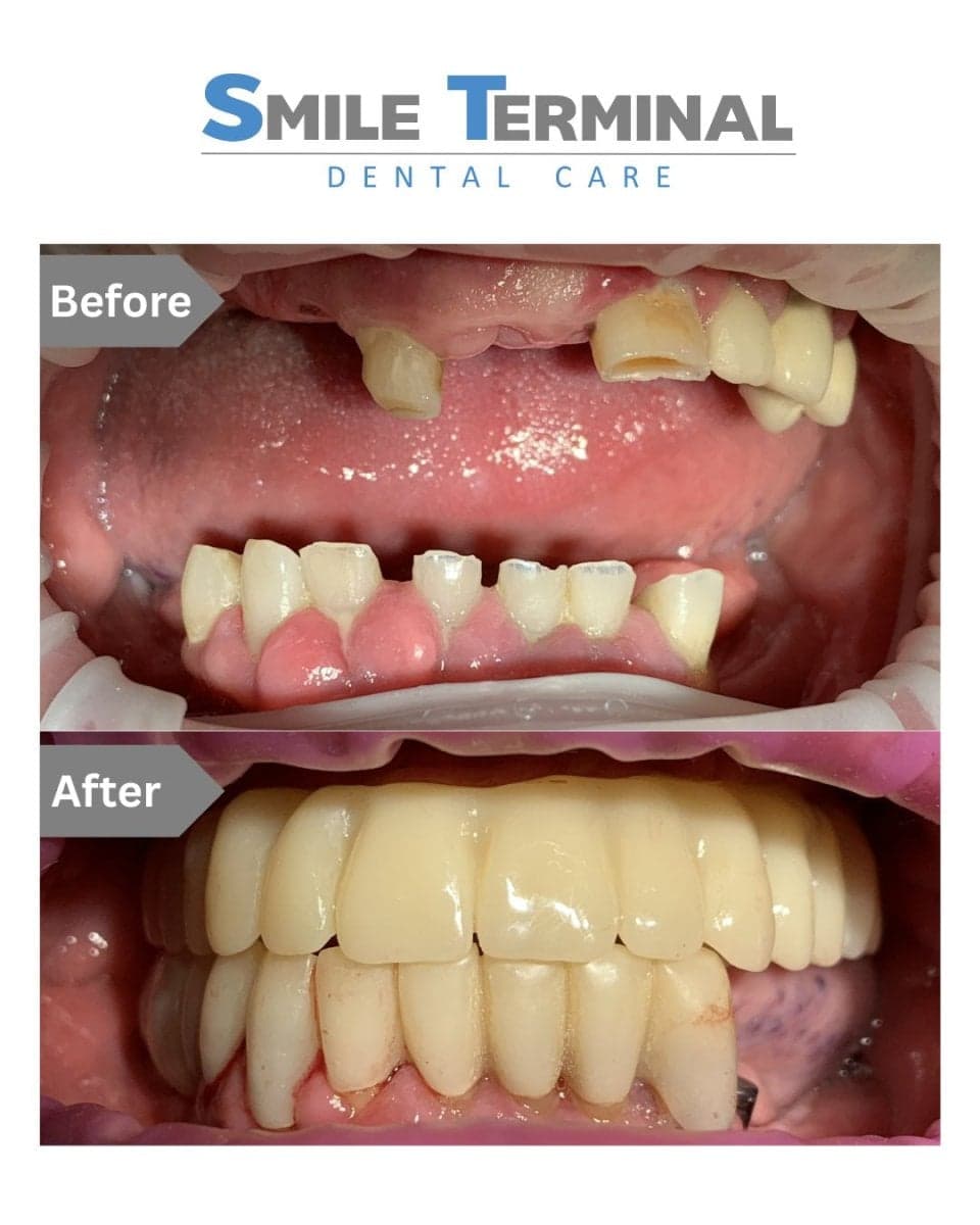 All-on-4 dental implants
