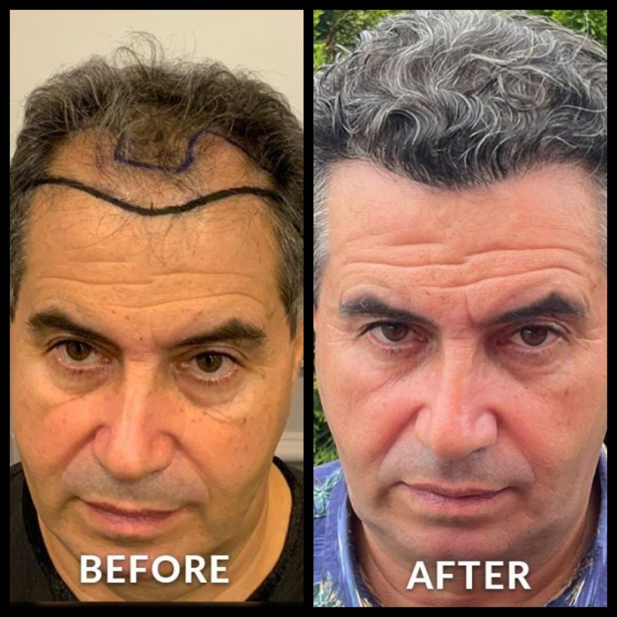 No Shave Hair Transplant