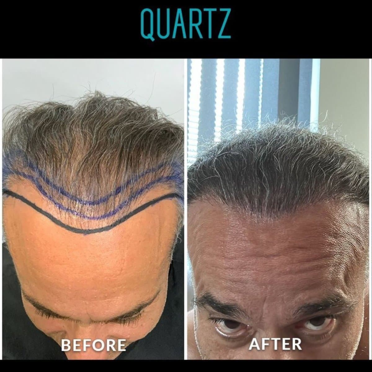 No Shave Hair Transplant