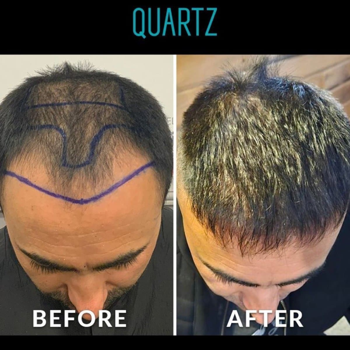 No Shave Hair Transplant
