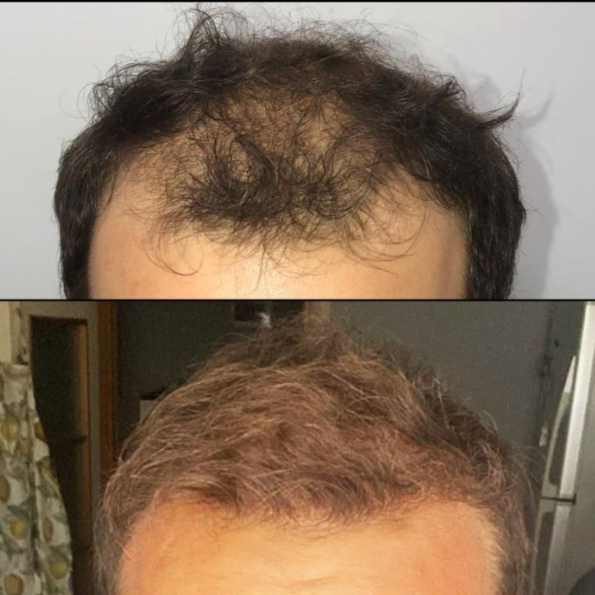 No Shave Hair Transplant
