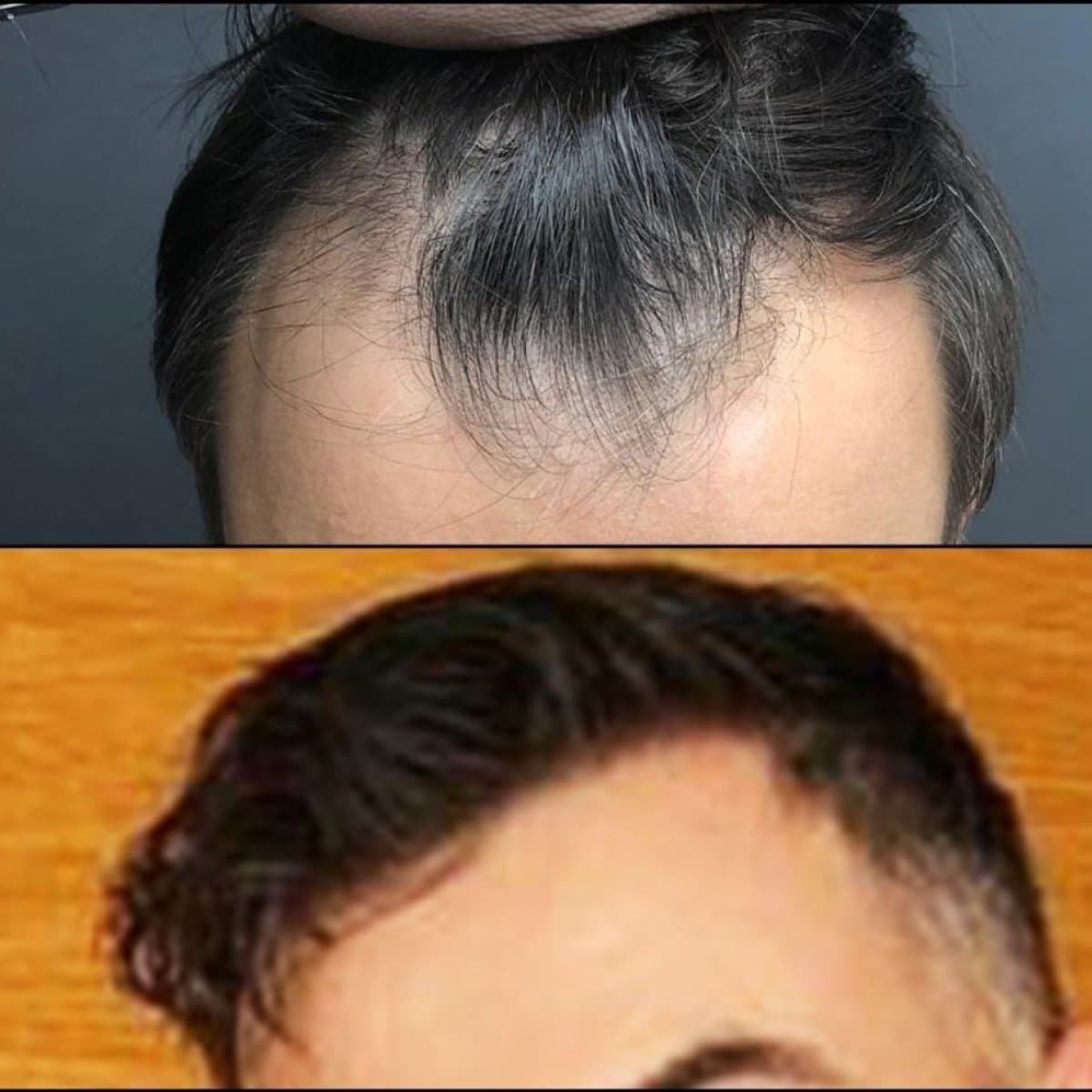 no shave hair transplant