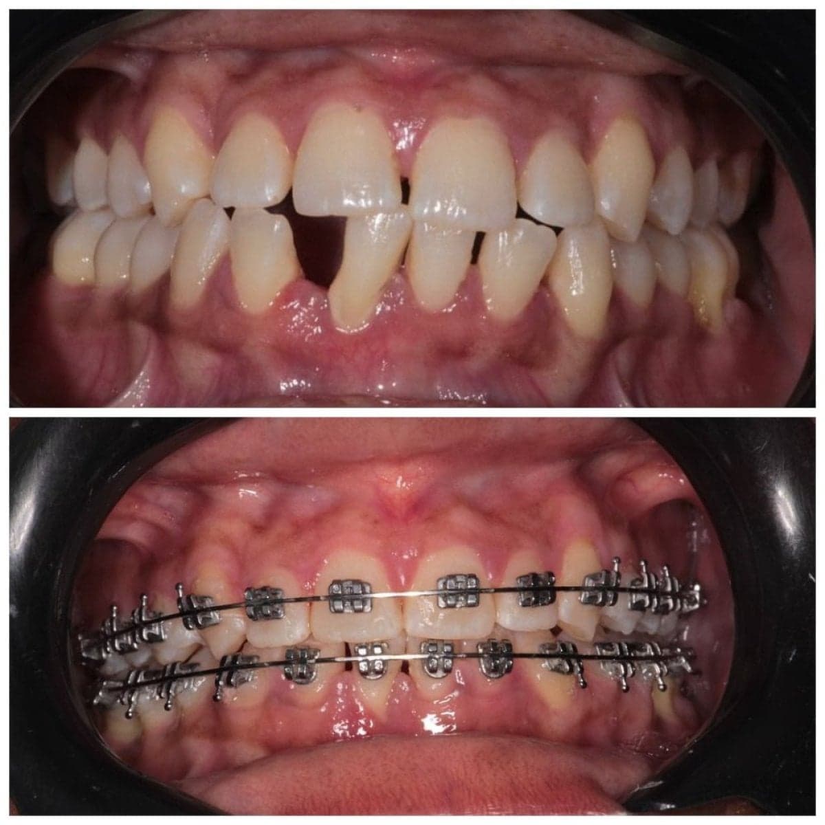 braces treatment