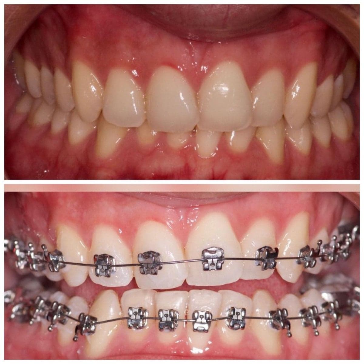 braces treatment