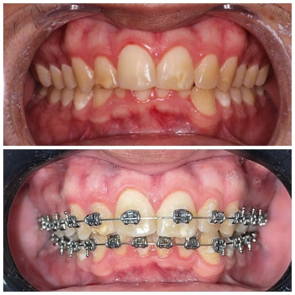 braces treatment