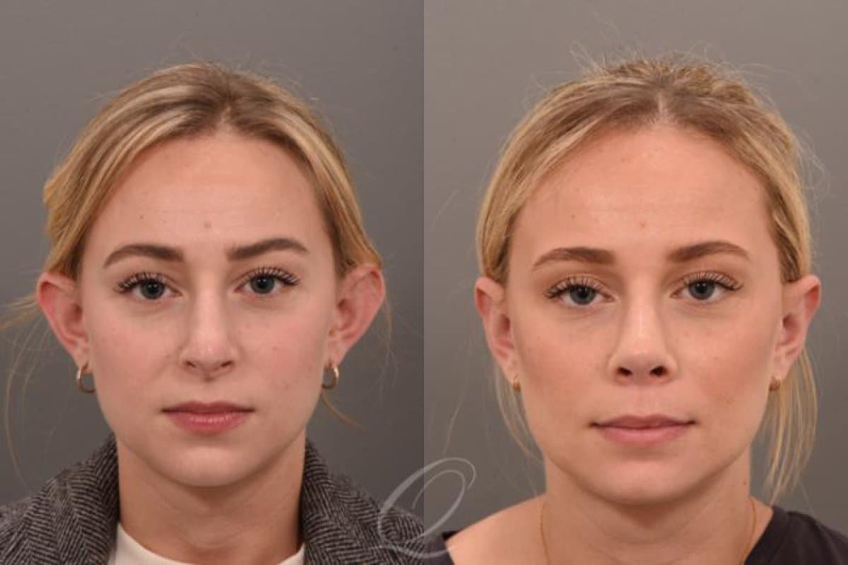 otoplasty
