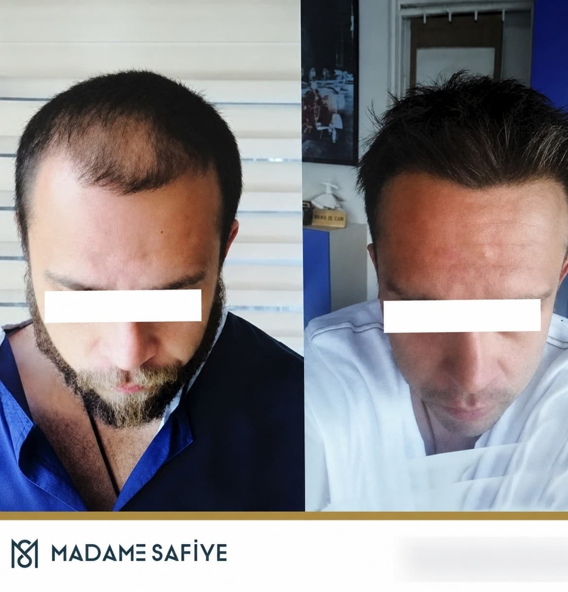 DHI hair transplant