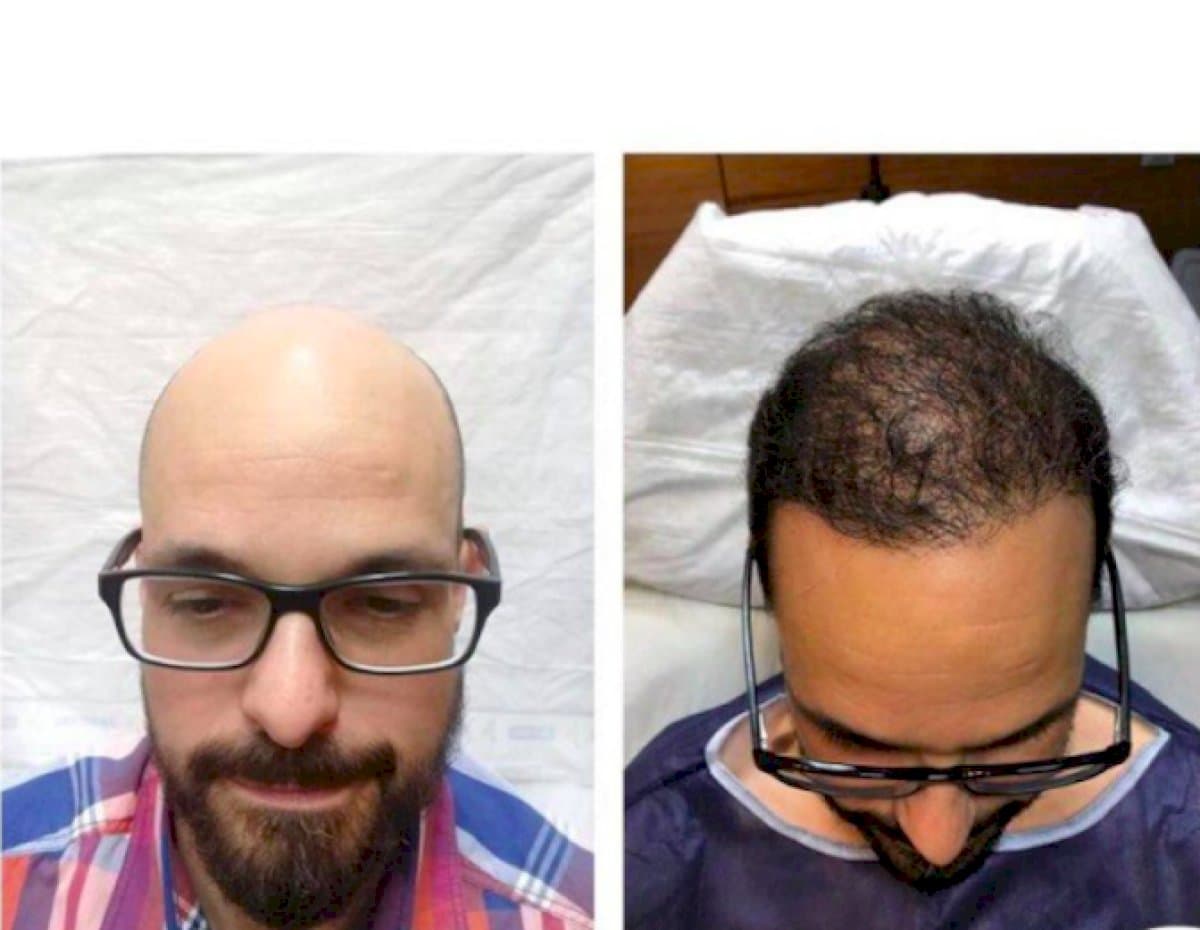 FUE hair transplant