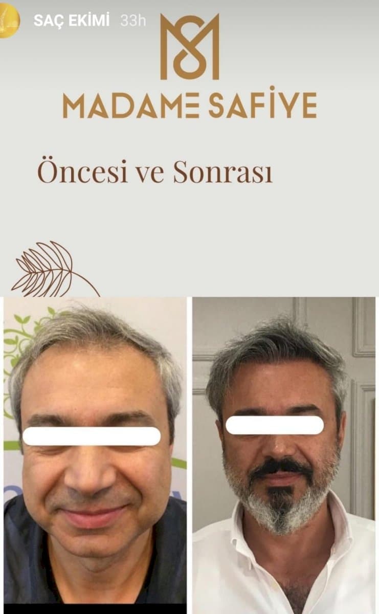 DHI hair transplant