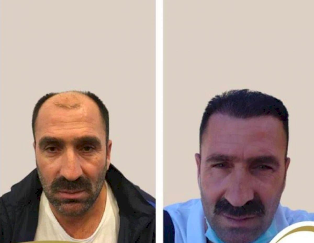 FUE hair transplant