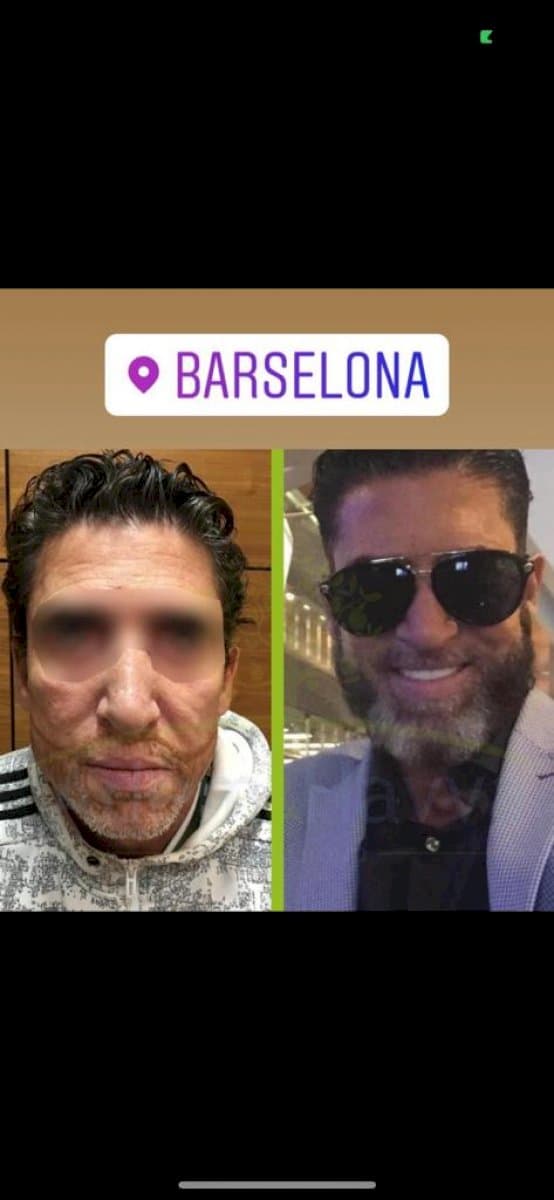 beard transplant