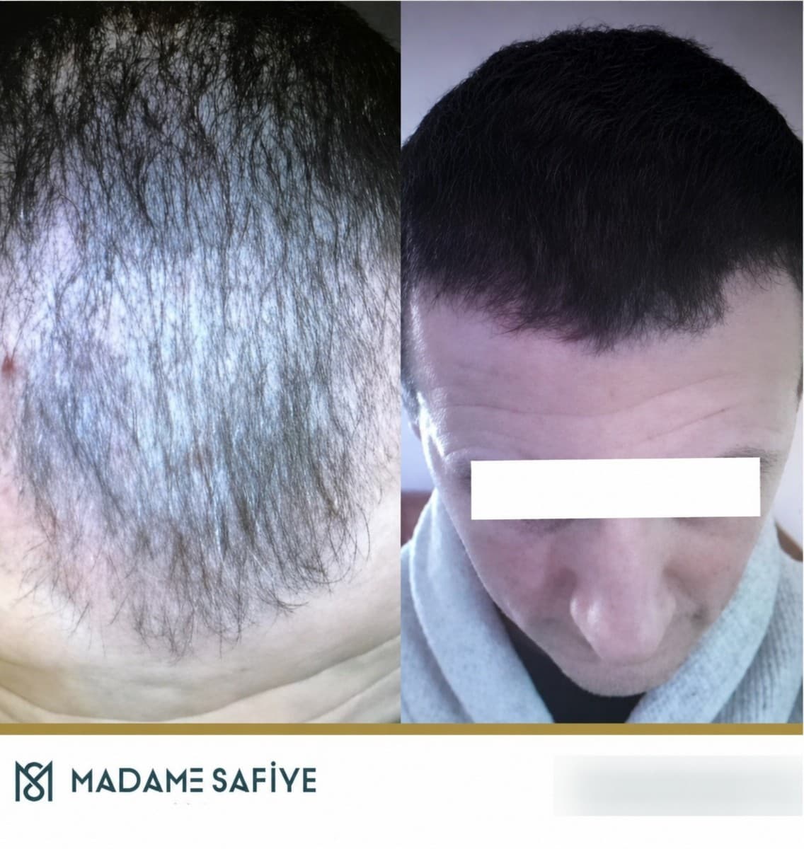 FUE hair transplant