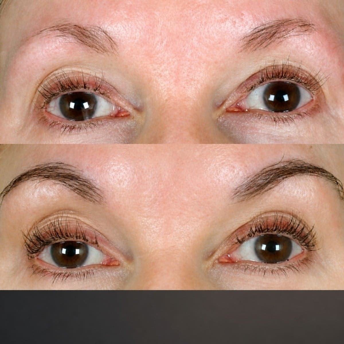eyebrow transplantation