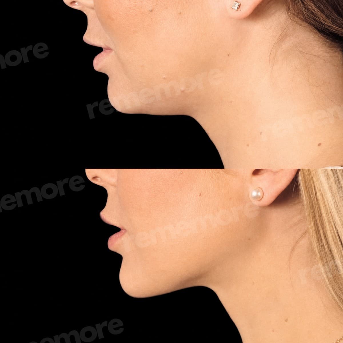 jaw shaping